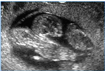 Figura 1 -   Imagem de exame ultrassonográfico de primeiro trimestre  demonstrando gestação gemelar monocoriônica  monoamniótica 
