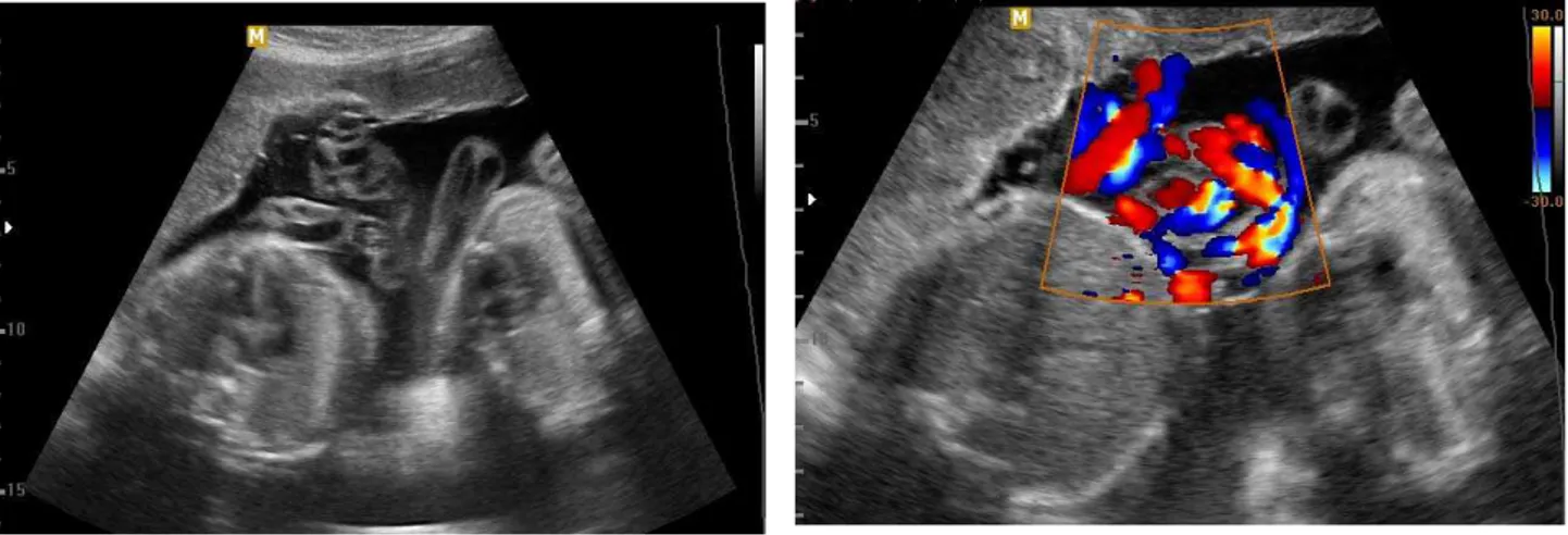 Figura 2 -   Imagens de exame ultrassonográfico de segundo trimestre  demonstrando gestação gemelar monocoriônica  monoamniótica com entrelaçamento de cordões 