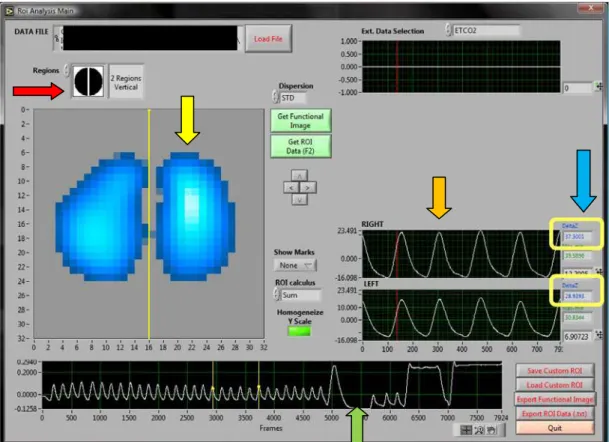 Figura 2 - Cálculo da média da variação da impedância em ventilação espontânea. 