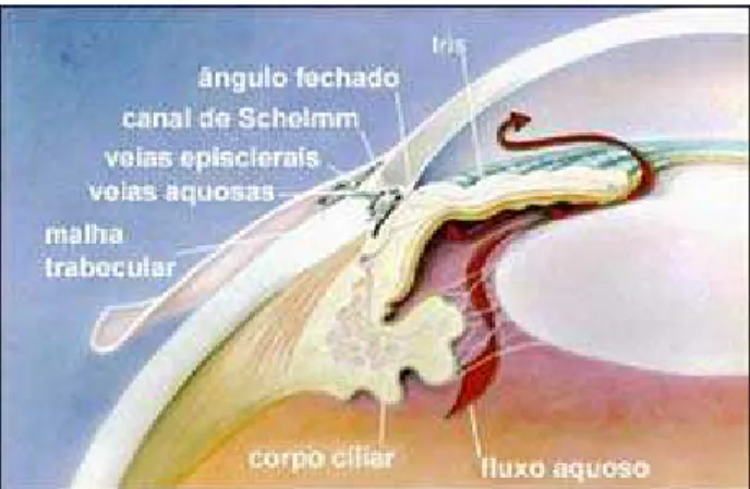 Figura 1.4 :  Anatomia do olho equacionando aspectos envolvidos no glaucoma de ângulo fechado (Portal  do ”Glaucoma”, 2010)
