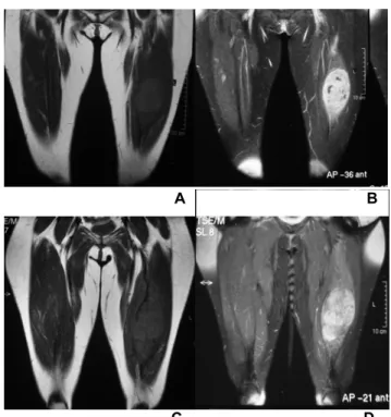 Figura 3- Exemplo de progressão de doença, segundo o critério RECIST: as figuras  A e B são referentes à RNM pré-quimioterapia em T1 antes e após 