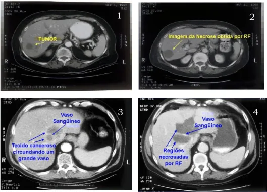 Figura 1.3 – Imagens de tomografia computadorizada de dois fígados acometidos por tumores
