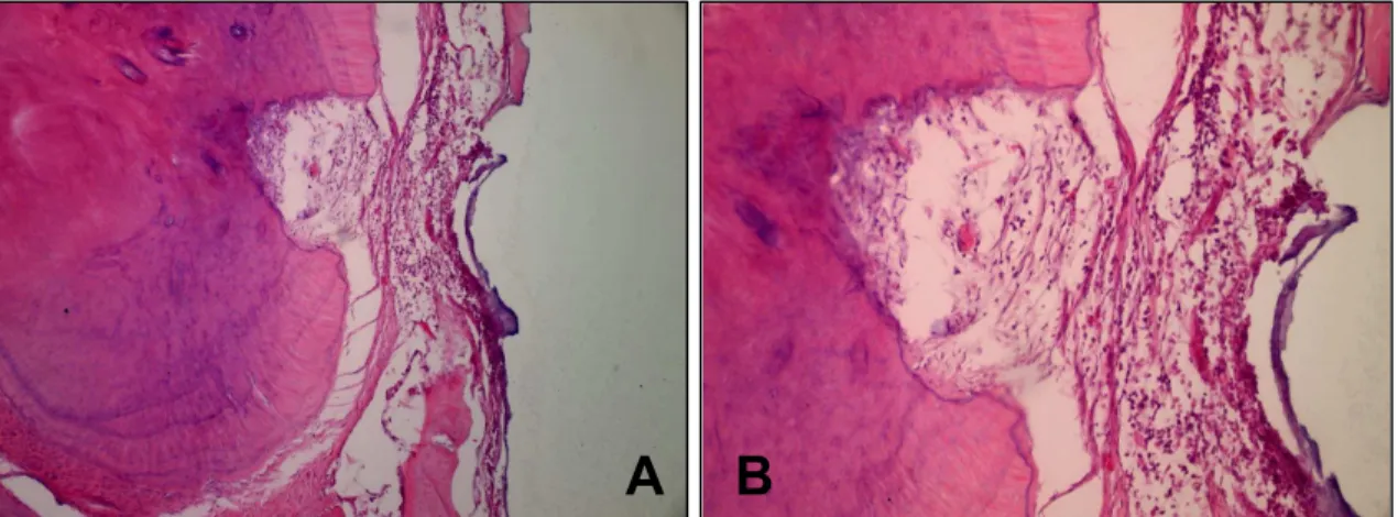 Figura 6A - Presença de reação inflamatória  moderada  próxima  a  foramina  apical,  associada a edema no espaço do ligamento  periodontal (100 X)