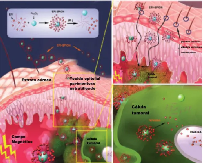 Figura 1.1. Ilustração que mostra a ação de nanocompósitos de epirrubicina-nanopartículas de  óxido de ferro no tratamento de câncer de pele