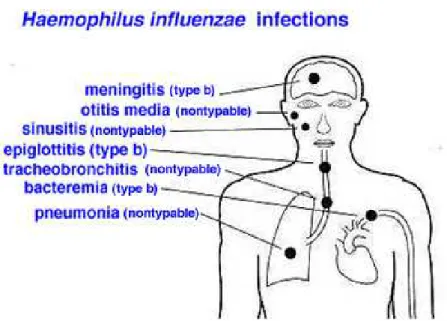Figura 2 . Infecções causadas pelo sorotipo b e por linhagens não tipáveis de  FONTE: &lt;http://www.textbookofbacteriology.net/haemophilus.html&gt; 