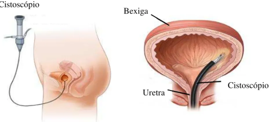 Figura 1.2  – Exame de cistoscopia transuretral para diagnóstico de câncer de bexiga. 