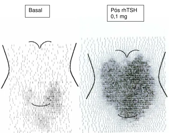 Figura 5 - Exemplo de cintilografia planar tiroidiana de paciente  do grupo I   em estudo basal e após estímulo com 0,1 mg de rhTSH, demontrando uma  maior homogenização na distribuição do I¹³¹ 