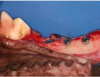 Figura 3. Implantes instalados na mandíbula após seqüência  de fresagem.