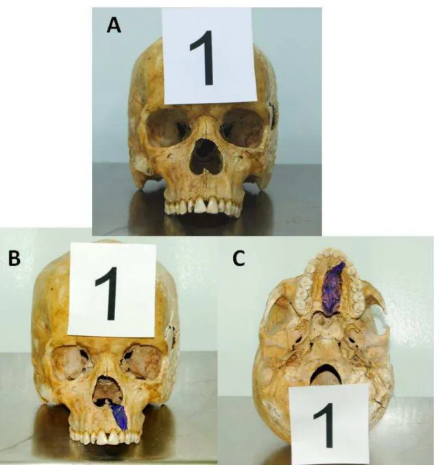 Figura  4.1  -  (A)  Vista  frontal  do  crânio  macerado;  (B)  Vista  frontal  do  crânio  com  o  desenho  do  defeito  ósseo  que  será  produzido  em  rebordo  alveolar  e  maxila;  (C)  Vista   ínfero-superior do crânio com o desenho do defeito ósseo
