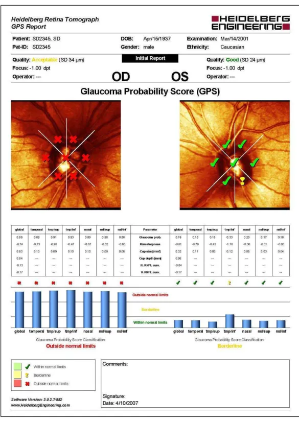 Figura 8.   Exemplo  de  um  impresso  do  HRT  com  o  resultado  da  análise  do  índice de probabilidade de glaucoma (GPS) 