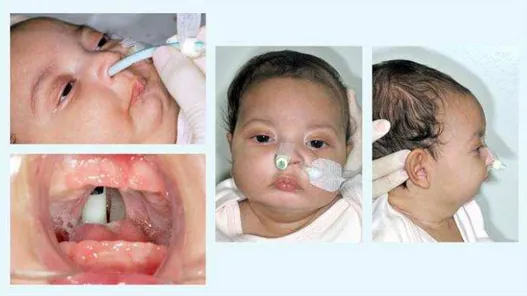 Figura 1 -  Paciente com Sequência de Robin utilizando a intubação nasofaríngea como  tratamento da obstrução das vias aéreas