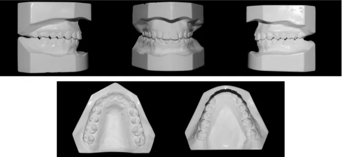 Figura 5. Modelos de pós-tratamento com o aparelhagem fixa (T3). 