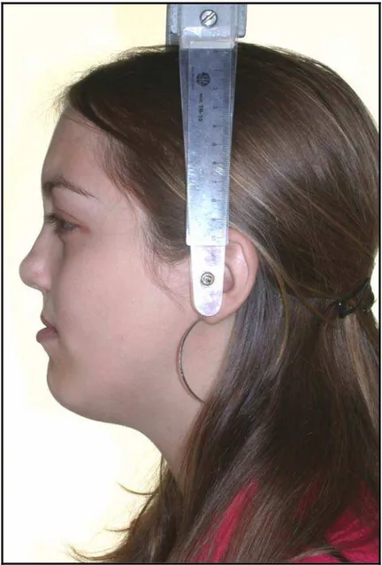 Figura 2 – Fotografia, em tamanho real, representativa do perfil  facial esquerdo de um dos pacientes da amostra 