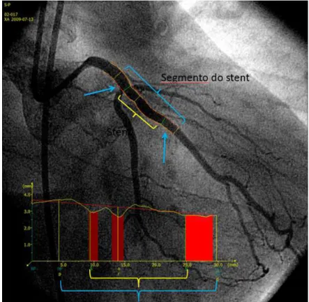 Figura  4  -  Local  de  interesse  para  análise  angiográfica  da  prova  de vasomotricidade