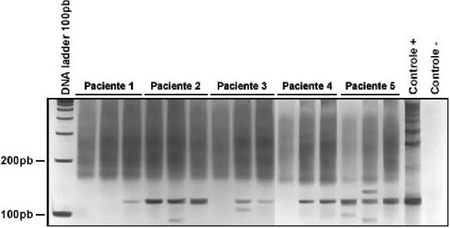 Figura 9 – Análise por PCR de 5 amostras de LCR de pacientes  sabidamente positivos para neurocisticercose