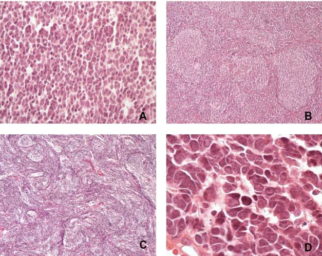 Figura  1  -  Tipos  histológicos  de  meduloblastoma.    A  -  Clássico  (400X);  B  -  Desmoplásico / nodular (100X); C - com extensa nodularidade (100X); D – Anaplásico  / grandes células (A/GC) (1000X) 