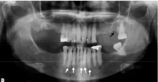 Fig. 4. Panoramic radiograph from a female patient under pamidronate therapy,  who developed osteonecrosis after extraction of 2 nd  upper left molar