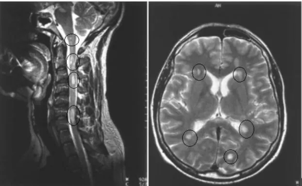 Figura 5 – Imagens características de Esclerose Múltipla  Fonte: SCOTTI e GEREVINI, 2001 