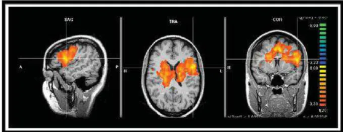 Figura 6 – Imagem representando análise de grupos de destros em tarefa  de Fluência Verbal Semântica, mostrando maior ativação na região frontal 