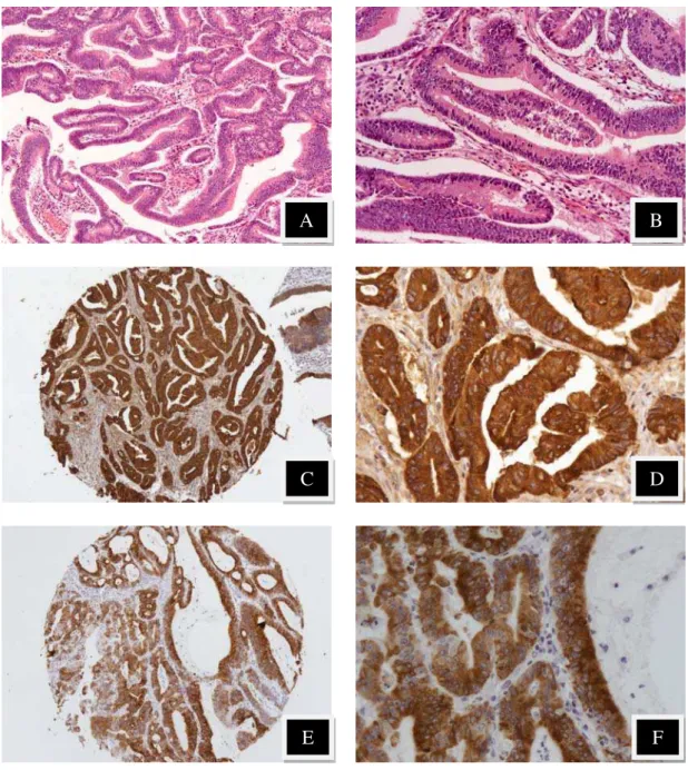 Figura 10: Adenocarcinoma túbulo-papilífero padrão gástrico – foveolar   A: H/E 10x. Arranjo obrigatoriamente túbulo-papilífero; 