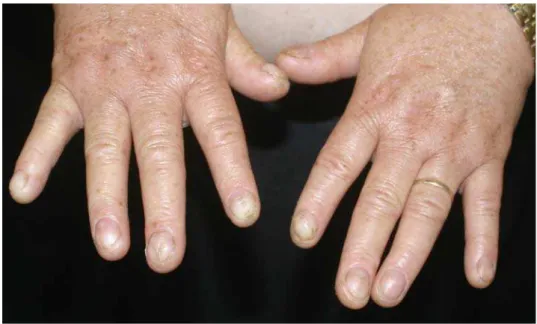 Figura 2 - Paciente II:2- mãos: distrofia das unhas e lentigos no dorso das mãos.