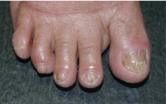 Figura 3 - Paciente II:2-unhas: distrofia das unhas do pé.