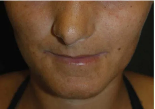 Figura 5 - Paciente III:2 – face: fotossensibilidade,  efélides, lábios finos e nariz alongado.