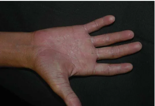 Figura 7 – Paciente III:4 – palma: dermatite esfoliativa das mãos e adermatoglifia.