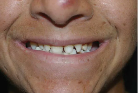 Figura 8 - Paciente III:4 - dentes: dentes cônicos, lábios finos.