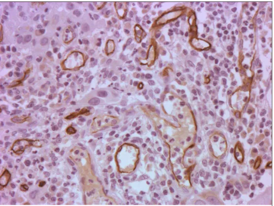 Figura  1.  Coloração  de  microvasos  (marrom)  por  anticorpos  anti-CD  34  em secção  de tumor (magnificação de 200X) 