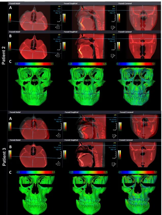 Figure  2  -  Patients  2  and  3,    (A)  multiplanar  slices  of  CBCT  volumes  before  cranial  base  superimposition  and  (B)  after  cranial  base  superimposition,  in  Ondemand3D,  showing  the  complete  correspondence  of  registration  in  all 