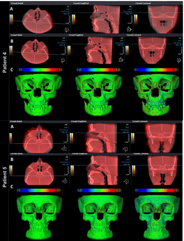 Figure  3  -  Patients  4  and  5,    (A)  multiplanar  slices  of  CBCT  volumes  before  cranial  base  superimposition  and  (B)  after  cranial  base  superimposition,  in  Ondemand3D,  showing  the  complete  correspondence  of  registration  in  all 