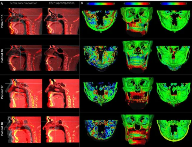 Figure  6.  CBCT  superimposition  of  non-growing  patients  subjected  to  orthognathic  surgery  with 1-year follow-up