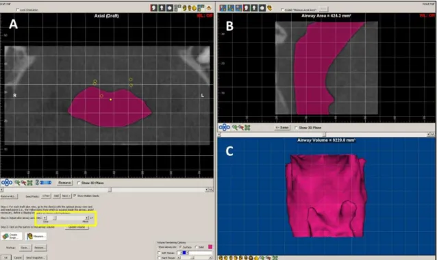Figura 1. Segmentação no programa Dolphin3D. Em (A) imagem axial e (B) sagital mostrando a  orofaringe corretamente preenchida pela segmentação