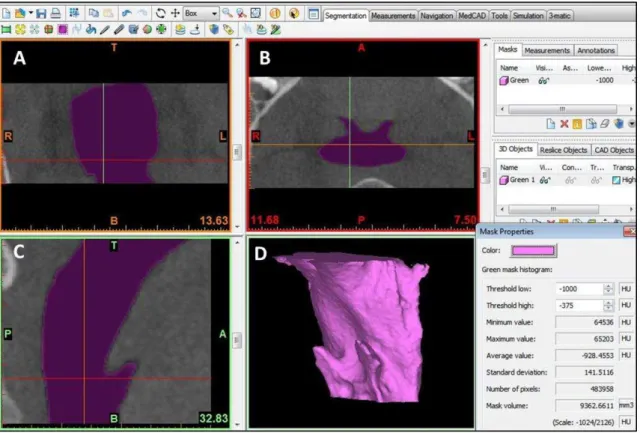 Figura 4. Segmentação da orofaringe no programa Mimics. Em (A) imagem coronal, (B) axial e  (C) sagital mostrando a orofaringe corretamente preenchida pela segmentação