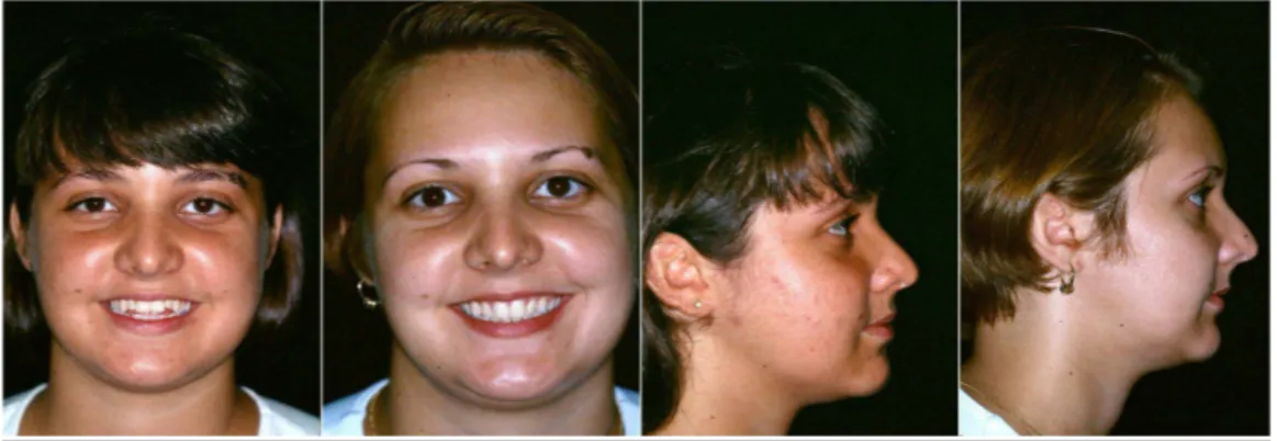 Figura 4.1: Fotos pré e pós tratamento em norma frontal e lateral do Grupo I - Compensatório