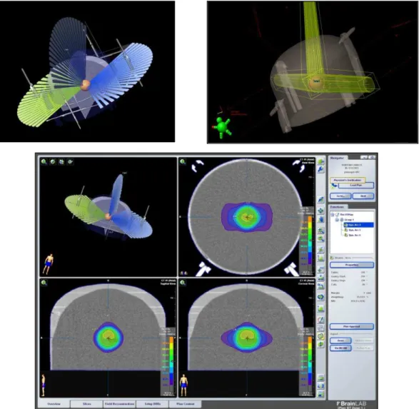Figura  24:  Planejamento  de  um  caso  de  meningioma  com  o  sistema  de  planejamento iPlan®, com três arcos dinâmicos