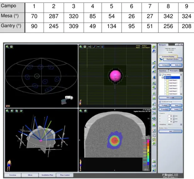 Figura 27: Planejamento do OS de cabeça com 9 campos não coplanares, para  a simulação de um tratamento de melanoma