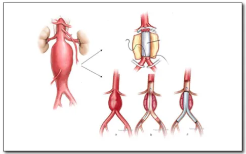 Figura  1.  Representação  do  aneurisma  de  aorta  abdominal;  (figura  superior)  representação  da  aneurismectomia;  (figura  inferior)  representação  da  técnica  endovascular