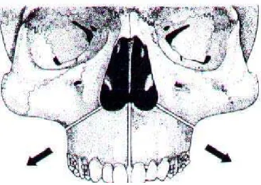 Figura 4: Desenho esquemático da Osteotomia Le Fort I  idealizada por Bell (1976) 