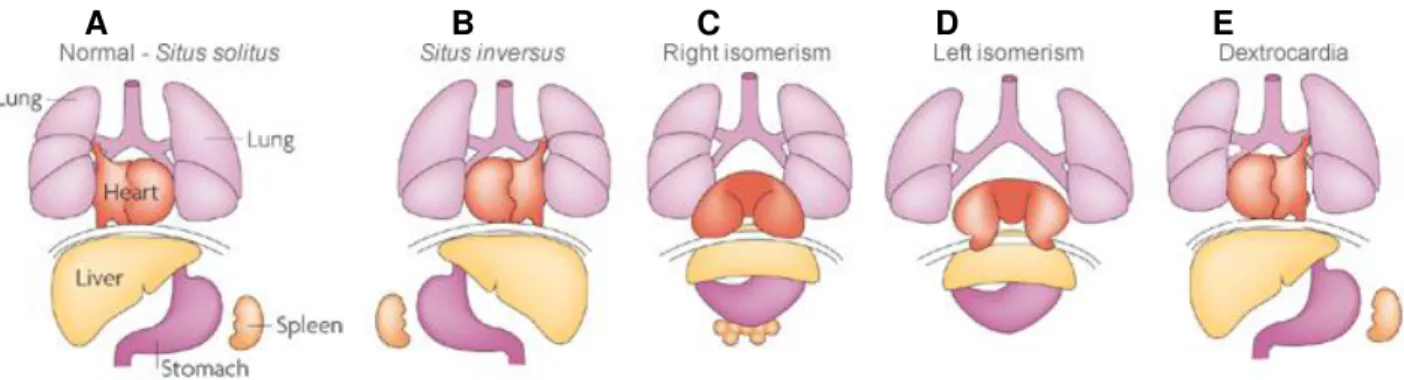 Figure 1.1 Human laterality problems. (A) Normal organization of the internal organs referred to as situs solitus