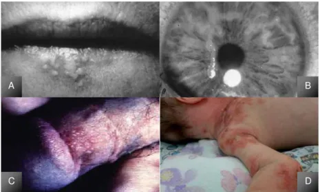 Figure 1.1: Herpesvirus induced lesions.  