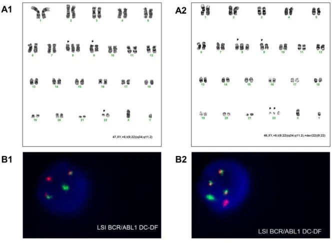Figure 2.2 Cytogenetic analysis for clinical case 44: A) karyotype banding and B) fluorescence in situ  hybridization  (FISH)  using  LSI  BCR/ABL1  Dual  Color,  Dual  Fusion  translocation  probe  (Abbott  Molecular,  Des  Plaines,  IL,  USA)