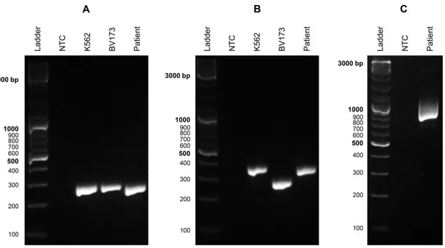 Figure 2.4 Sequence analysis of  BCR-ABL1 from patient sample 44. A) Sanger sequencing of PCR  product represented in figure 2.3B (patient)