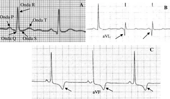 Figura  3.  Ritmo  cardíaco  em  ECG.  (A)  Padrão  de  ECG  normal  (B)  ECG  de  paciente  de  MH  com  ondas  Q  profundas (C) ECG de paciente de MH com inversão das ondas T (Kelly et al, 2007)