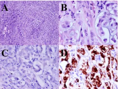 Figure II.9 - Representative images of a tumor xenograft stained with HE (A, B), and the immunostaining for  cytoplasm cytokeratins (C) and for vimentin (D)