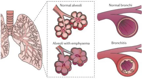 Figure  1.2.  COPD  Phenotypes.  Emphysema  and Chronic  Bronchitis  are  the most  common  COPD  phenotypes, characterized by thickening and consequent destruction  of alveoli,  and obstruction of airflow  by mucus and inflammatory  cells, respectively