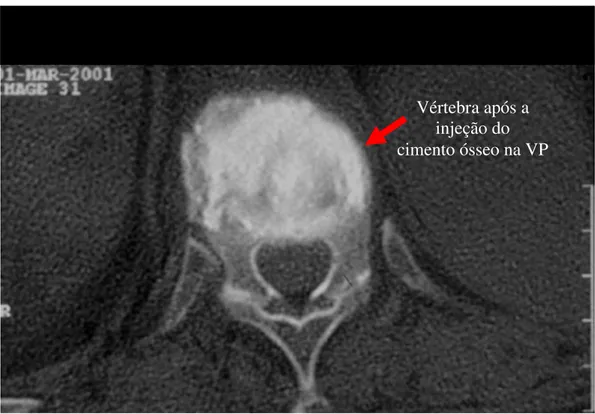 Figura 1. TC do segmento toracolombar da coluna (corte axial) após a VP mostrando o  cimento ósseo preenchendo o corpo vertebral fraturado (VP n o 