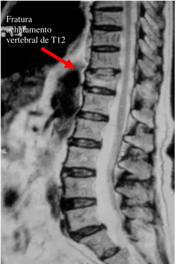 Figura  2. Ressonância magnética do segmento  toracolombar da coluna (corte sagital), mostrando a  vértebra fraturada, com hipersinal em T2 (VP n o 