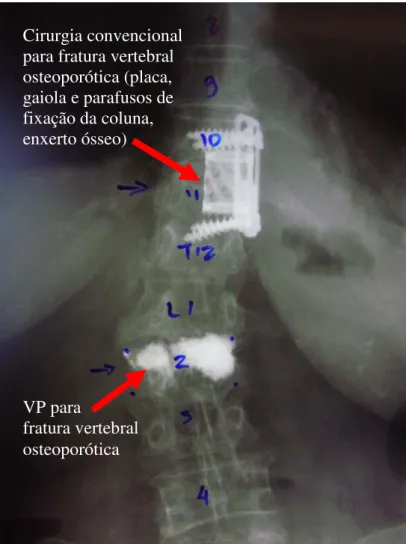 Figura 4. Rx do segmento toracolombar da coluna (em AP),  mostrando o caso de uma paciente de 78 anos, que  apresentava discopatia, escoliose e fraturas vertebrais  osteoporóticas, sendo que a de T11 comprimia a medula  espinal (sem déficit neurológico), e